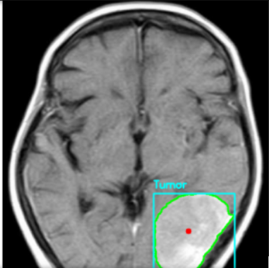 Brain MRI AI